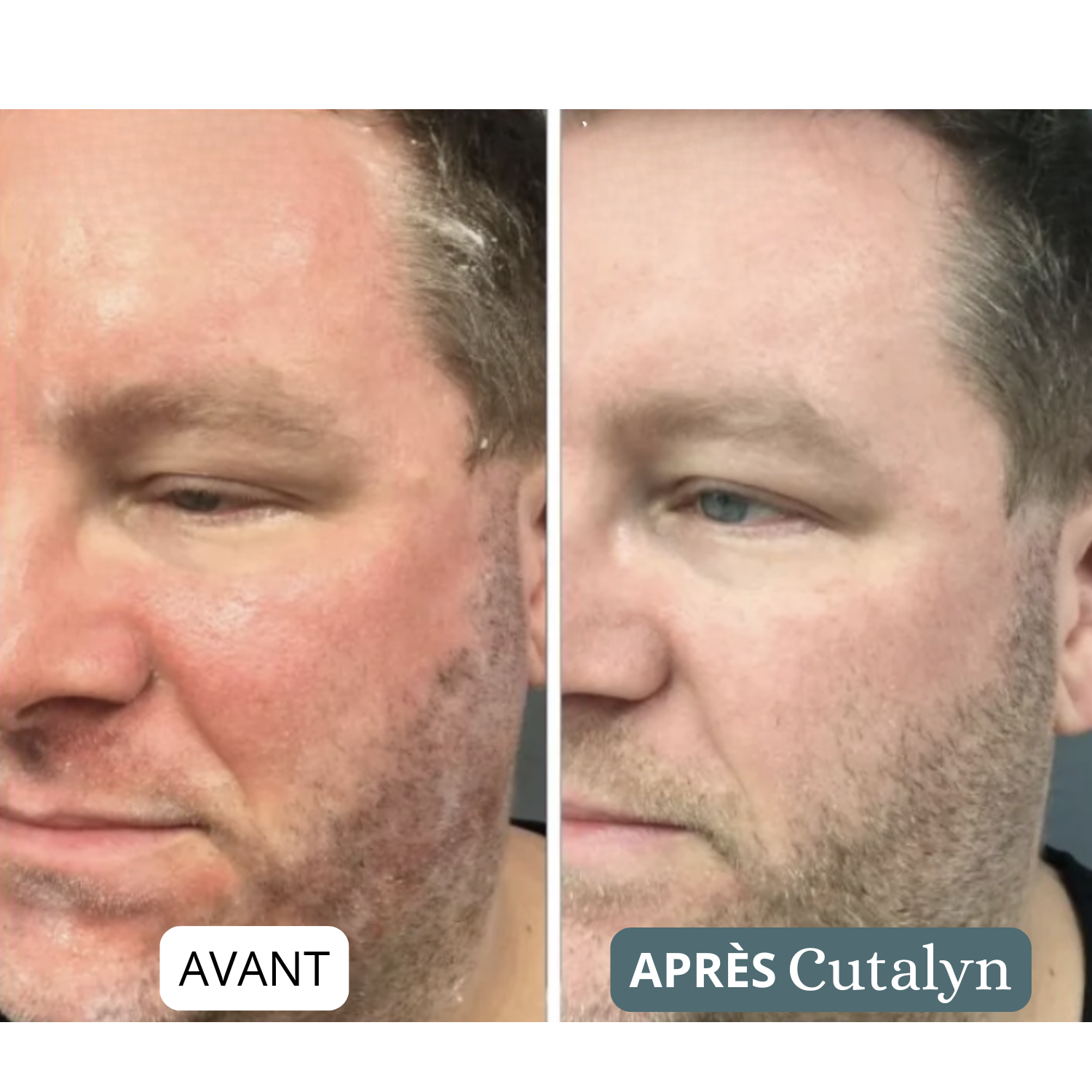 SensiCalm® Duo+ ⎜ Barbe & cuir chevelu apaisés